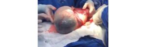 Bebê nasce empelicado em parto gemelar e vídeo impressiona
