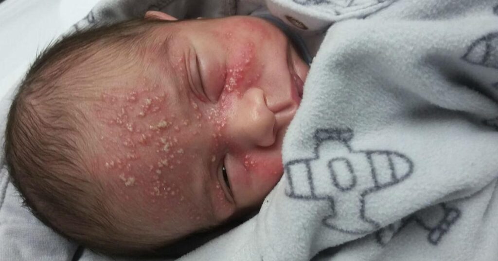 Ele contraiu herpes após uma visita beijá-lo