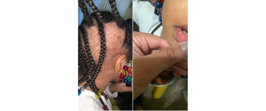 A menina teve os cabelos arrancados na escola