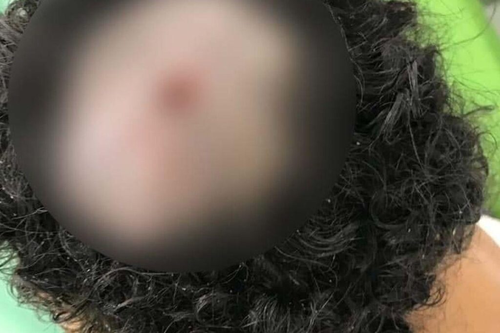 A larva é identificada como “berne”