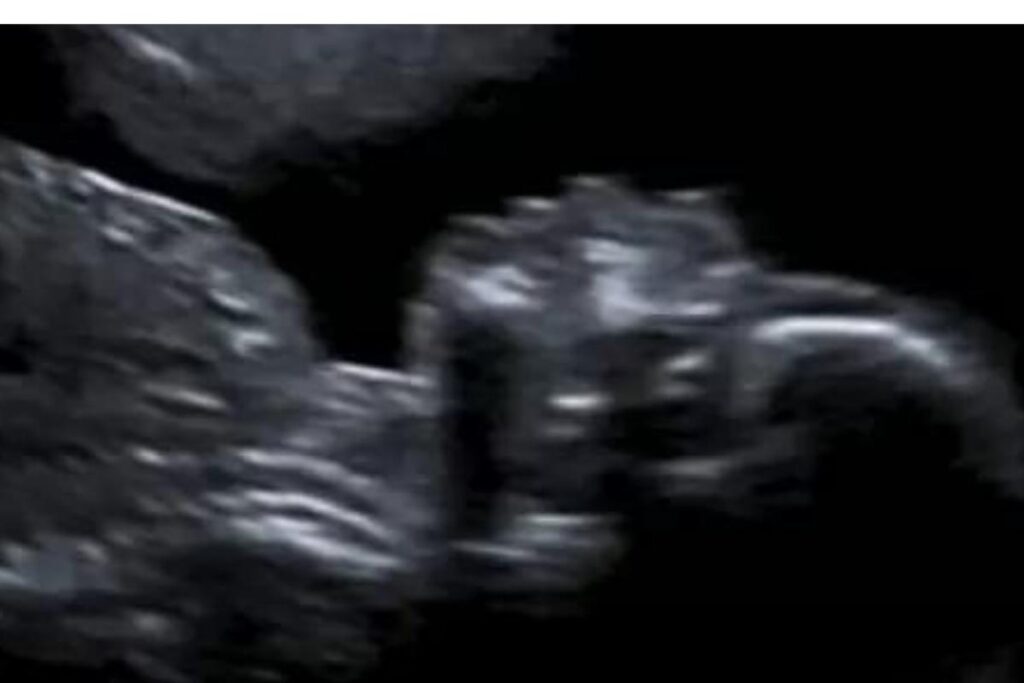 Stacey Astley decidiu ter uma pausa depois das perdas gestacionais