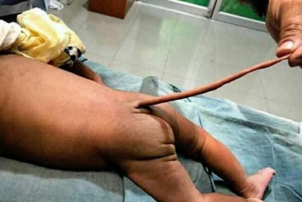 Bebê nasce com cauda em Fortaleza