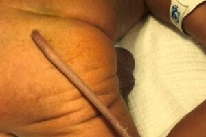 Bebê brasileiro nasce com cauda de 13 centímetros em caso raríssimo e fotos impressionam