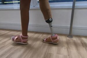 Graças à nova prótese, Júlia voltou a brincar como as demais crianças