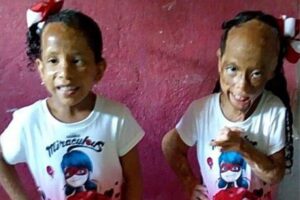 As meninas sofreram queimaduras de terceiro grau