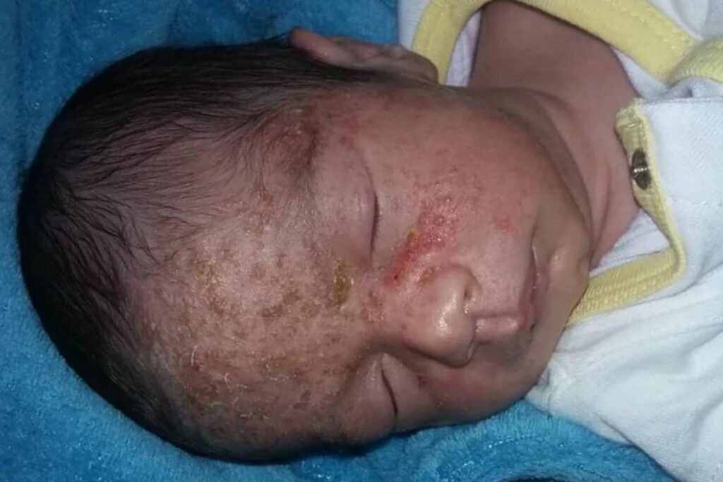 O bebê contraiu herpes