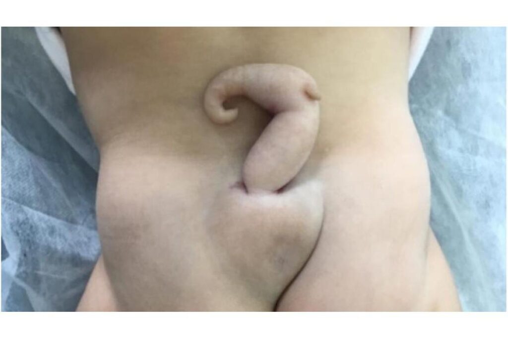 Bebê nasce com ‘cauda’ de 6 centímetros no Brasil e caso raro é divulgado