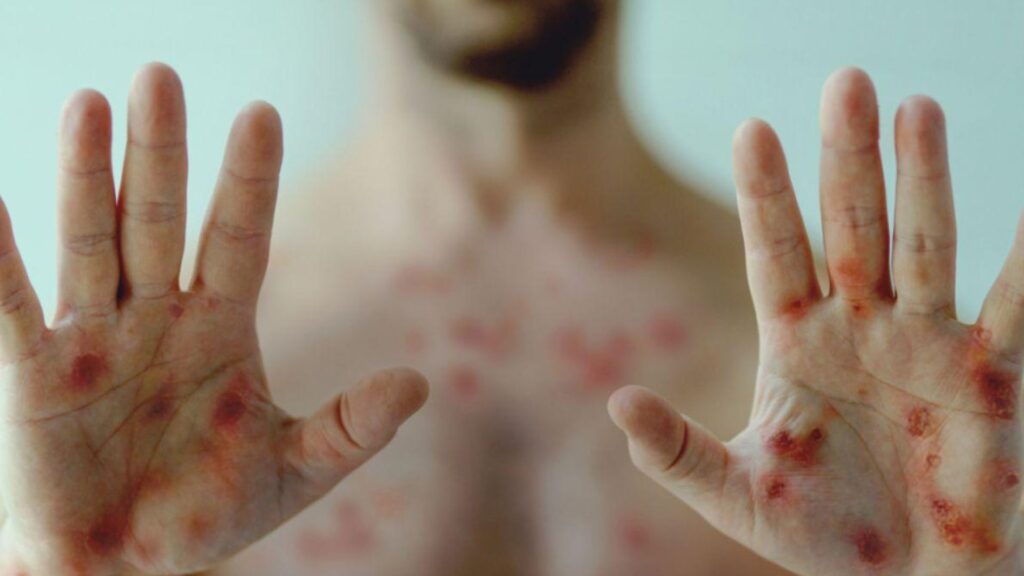 OMS faz reunião de urgência devido a monkeypox