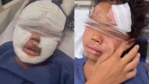 Pediatra mostra rosto de criança após ‘trend’ famosa do ovo: “Explodiram na minha cara”