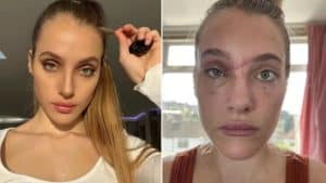 Modelo sofre acidente de moto após ser atingida por ave e agora luta contra perda de memória