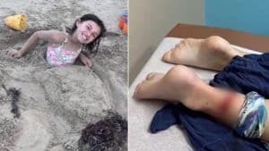 Menina de 8 anos é atacada por tubarão em praia no Texas e passa por cirurgia