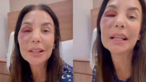 Ivete Sangalo fala sobre detalhes de cirurgia após acidente: “Quebrei dois ossos”