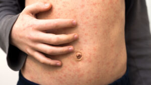 Sarampo: casos nas Américas são os maiores em 22 anos; veja sintomas e como prevenir